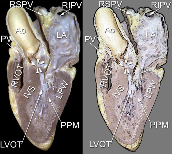 Left ventricle left parasagital view